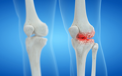 3d rendered medically accurate illustration of an arthritic knee