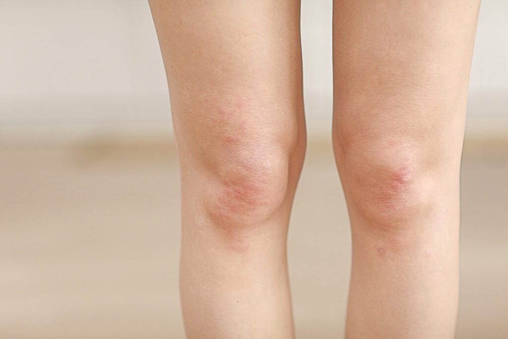 Close-up of knees showing cartilage damage and inflammation, representing knee pain treated with the MACI regenerative cartilage therapy in Houston and Pearland, TX.
