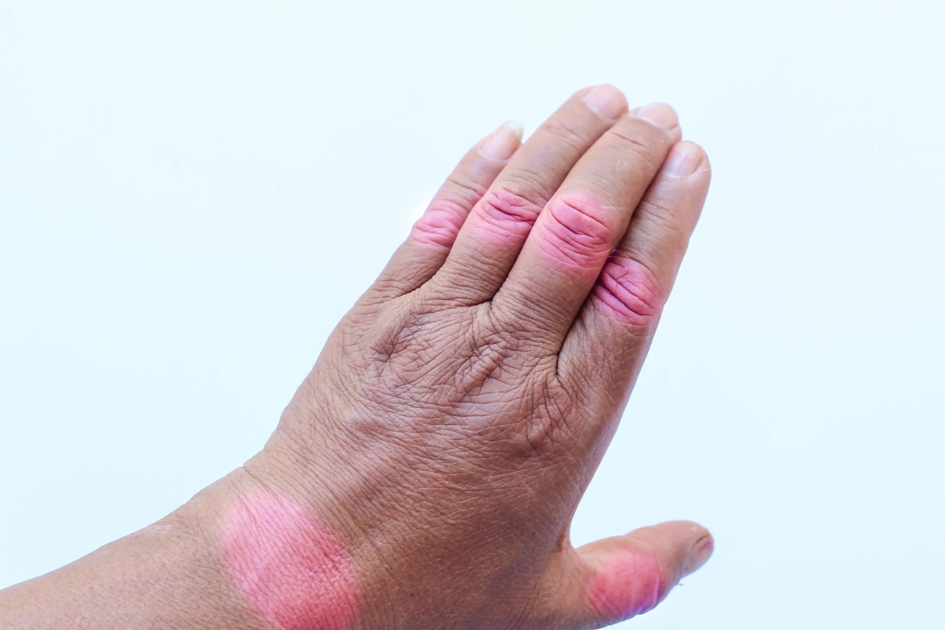 can-arthritis-kill-you